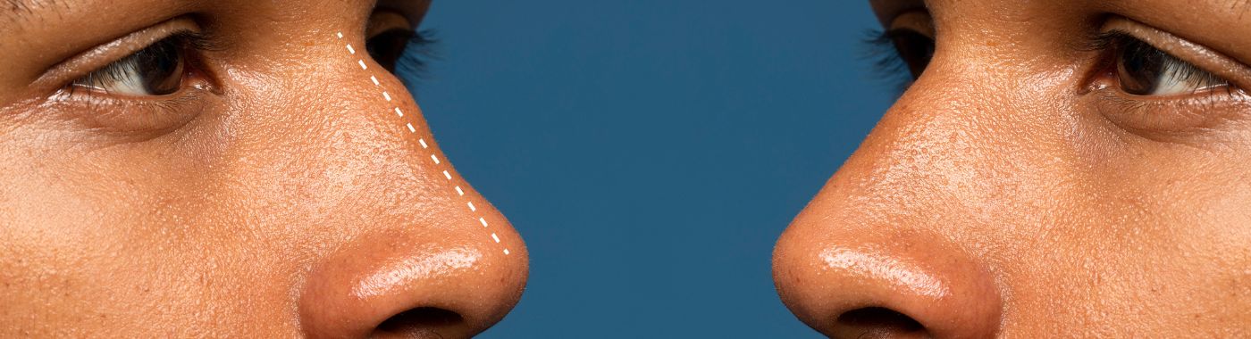 Rhinoplasty - Procedures, Preparation, Cost, and Recovery