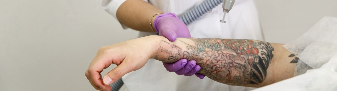 Tattoo Removal