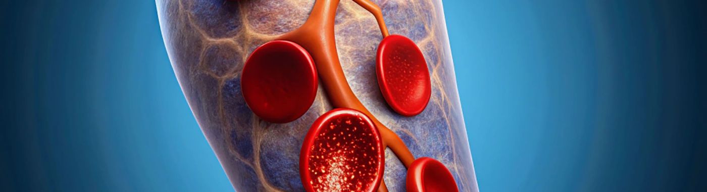 Thrombolysis - Procedures, Preparation, Cost, and Recovery