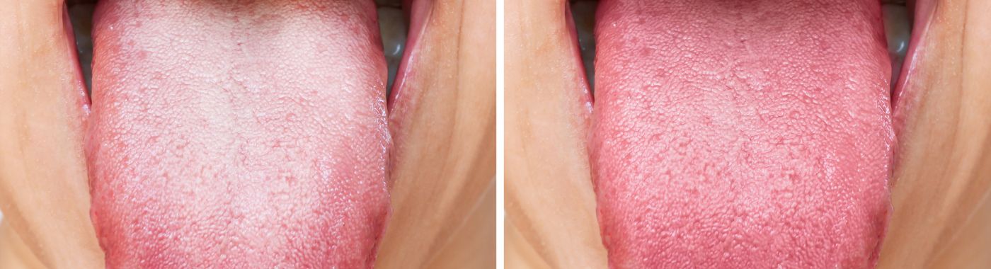 Tongue color