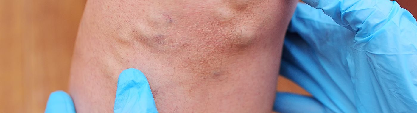 Venography - Procedures, Preparation, Cost, and Recovery