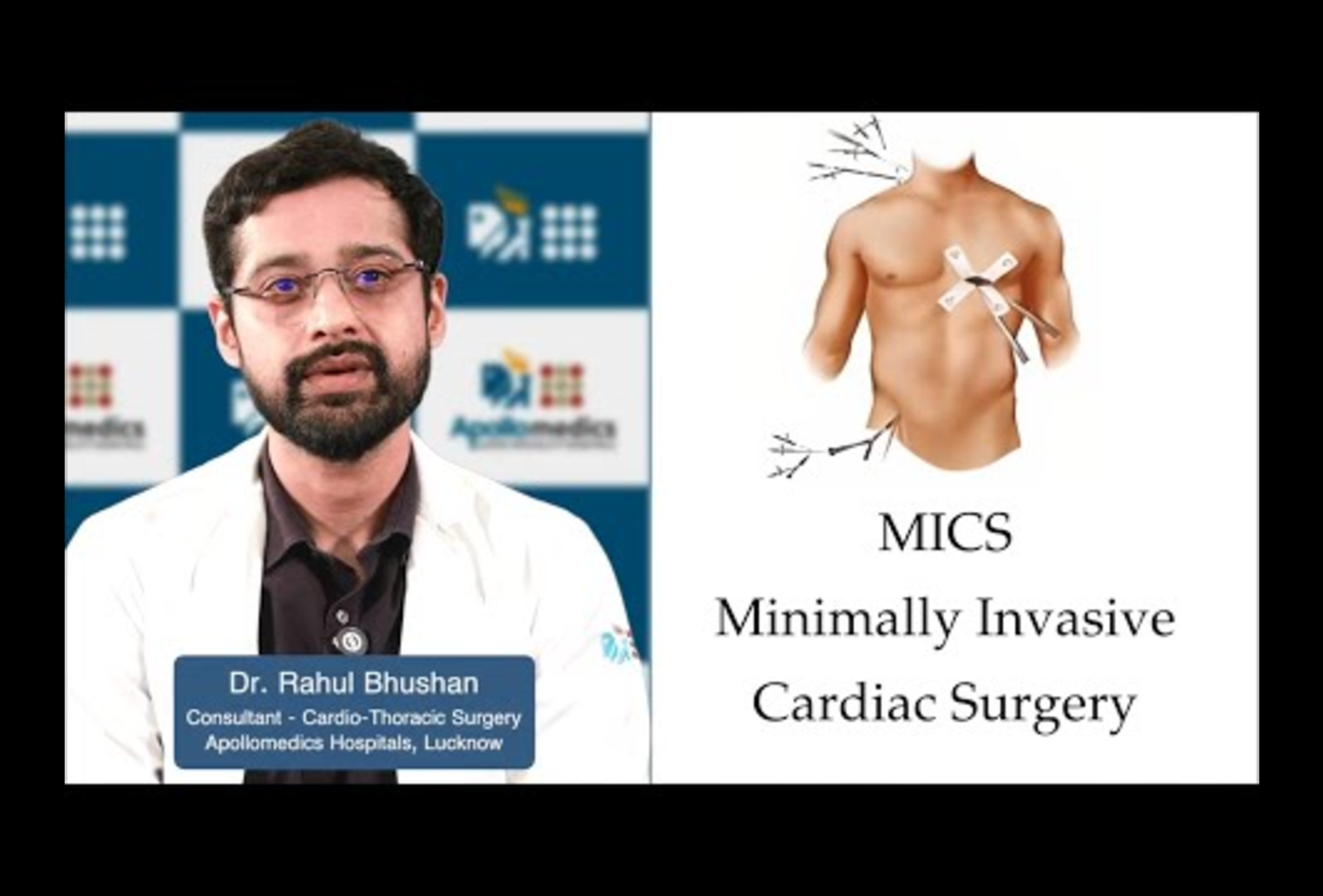 Minimally Invasive Cardiac Surgery (MICS)