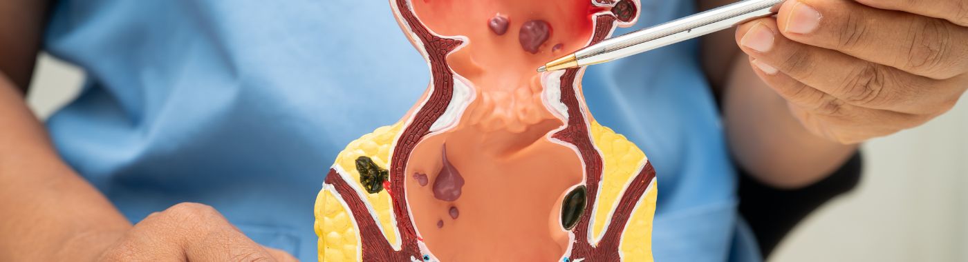 అనల్ పాలీపెక్టమీ - ఖర్చు, సూచనలు, తయారీ, ప్రమాదాలు మరియు కోలుకోవడం