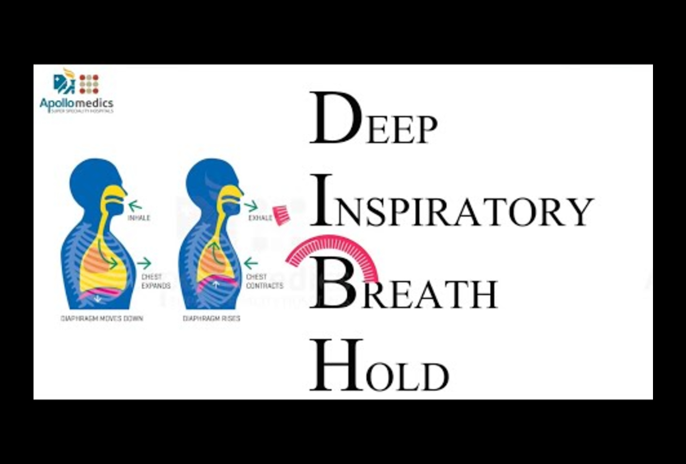  DIBH Technique for Breast Cancer Treatment
