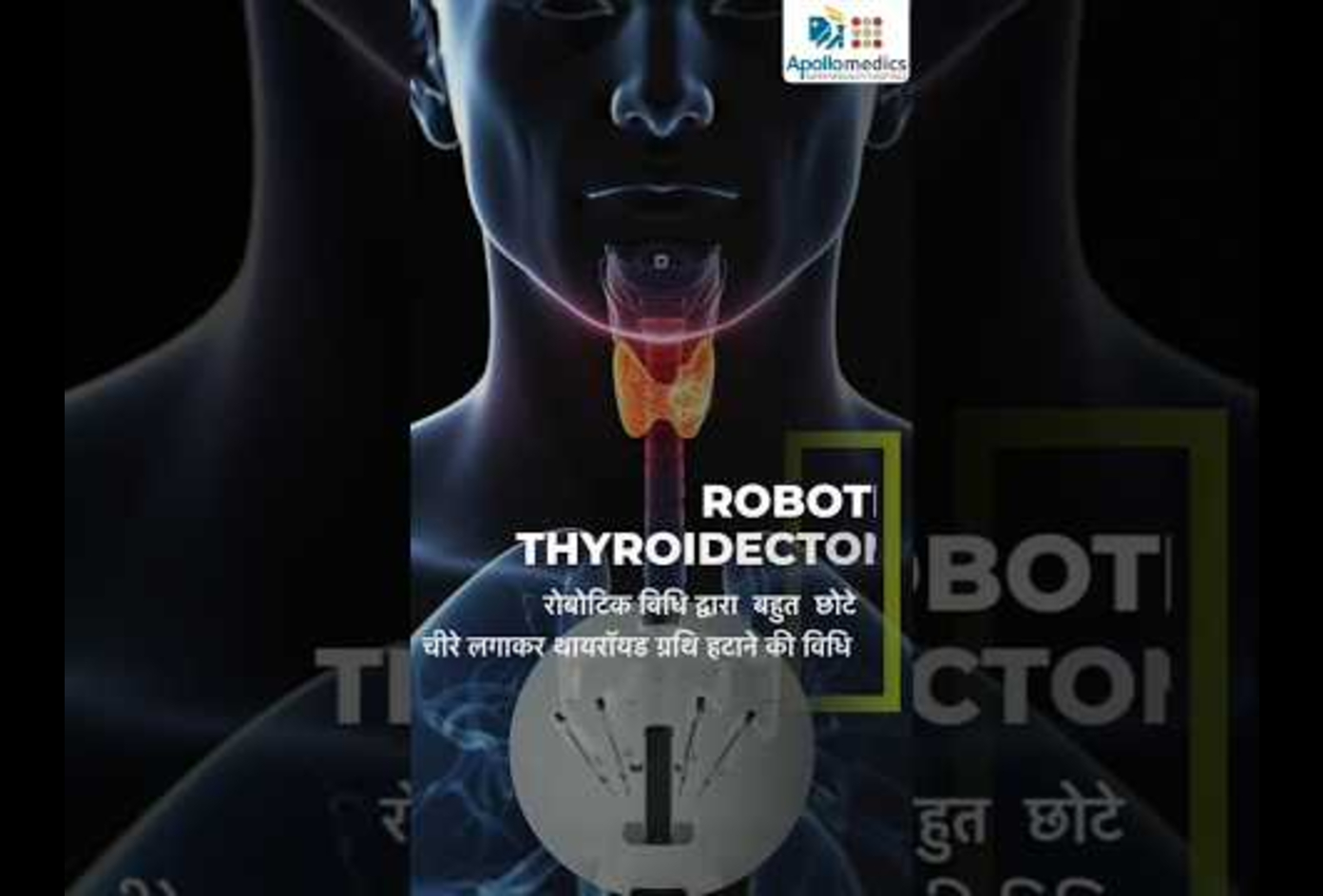 Robotic Thyroidectomy