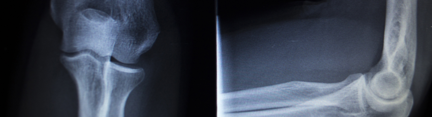 Elbow X-Ray