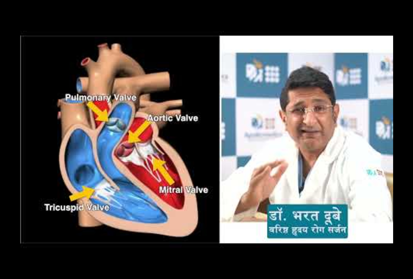 heart valves include stenosis 