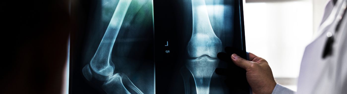 Knee X-Ray