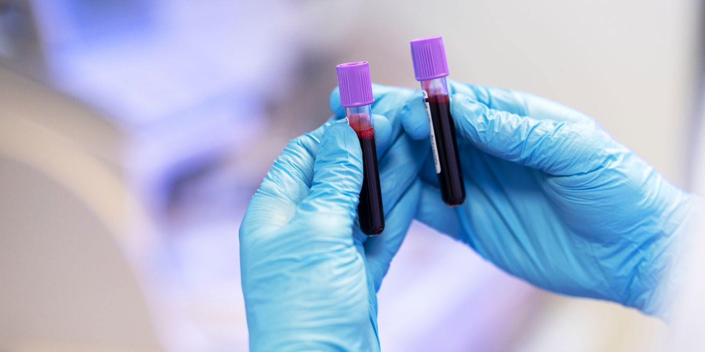 RDW Blood Test