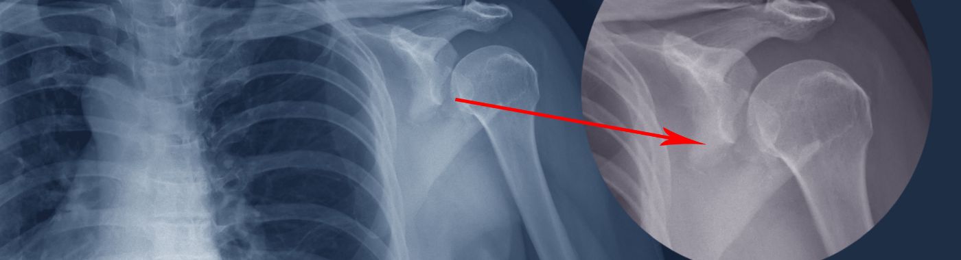 Shoulder X-Ray