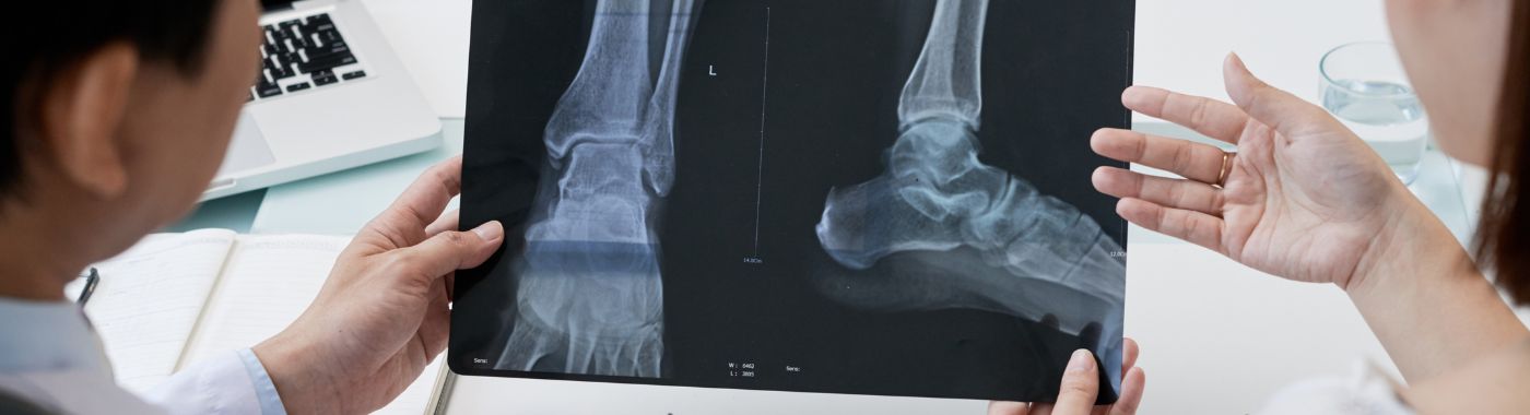 What is Ankle Fusion (Arthrodesis)