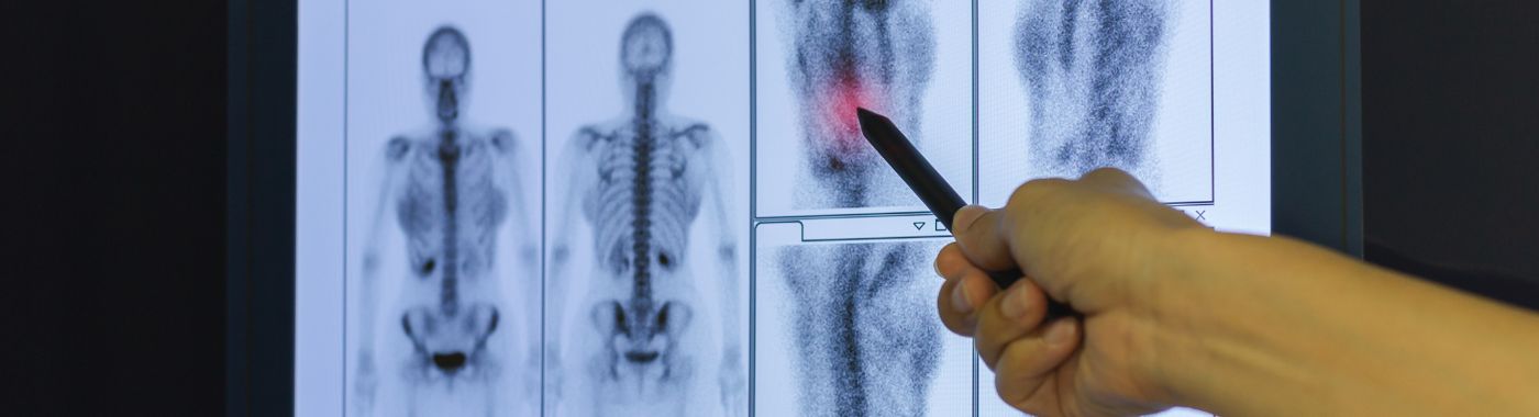 Whole-Body Bone Scan