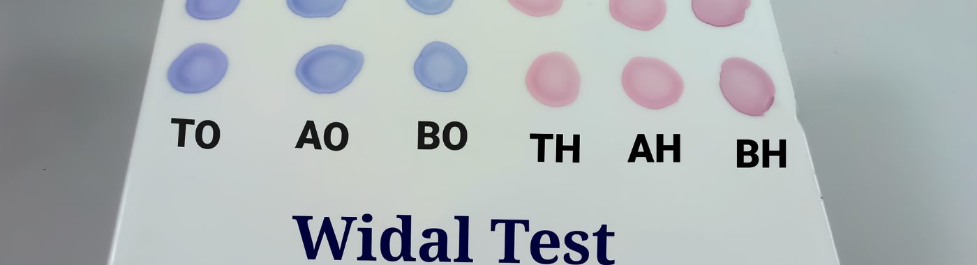 Widal Test