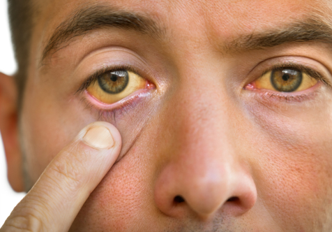 Jaundice Clinic