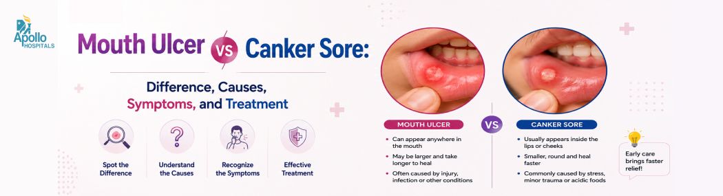 Mouth Ulcer vs Canker Sore | Causes & Treatment