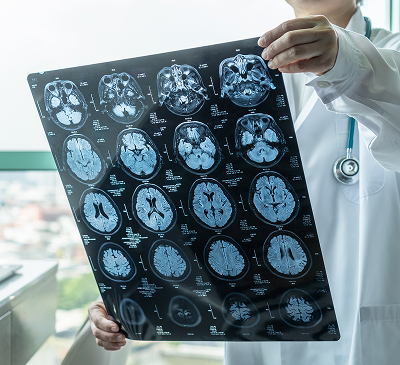 Brain Stroke thumbnail