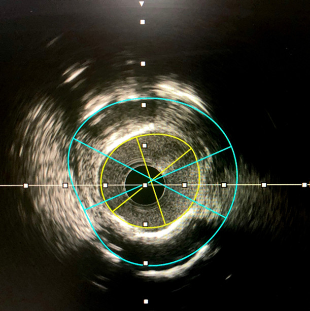 Intravascular imaging and physiology tools