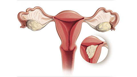 endometrial-cancer