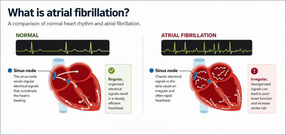 Comparison of normal heart rhythm and atrial fibrillation showing regular and irregular electrical signals