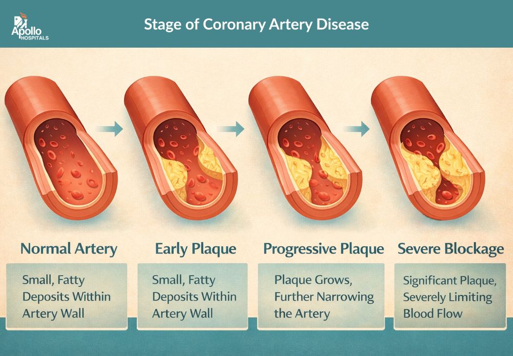 Coronary Artery Disease (CAD) Stages