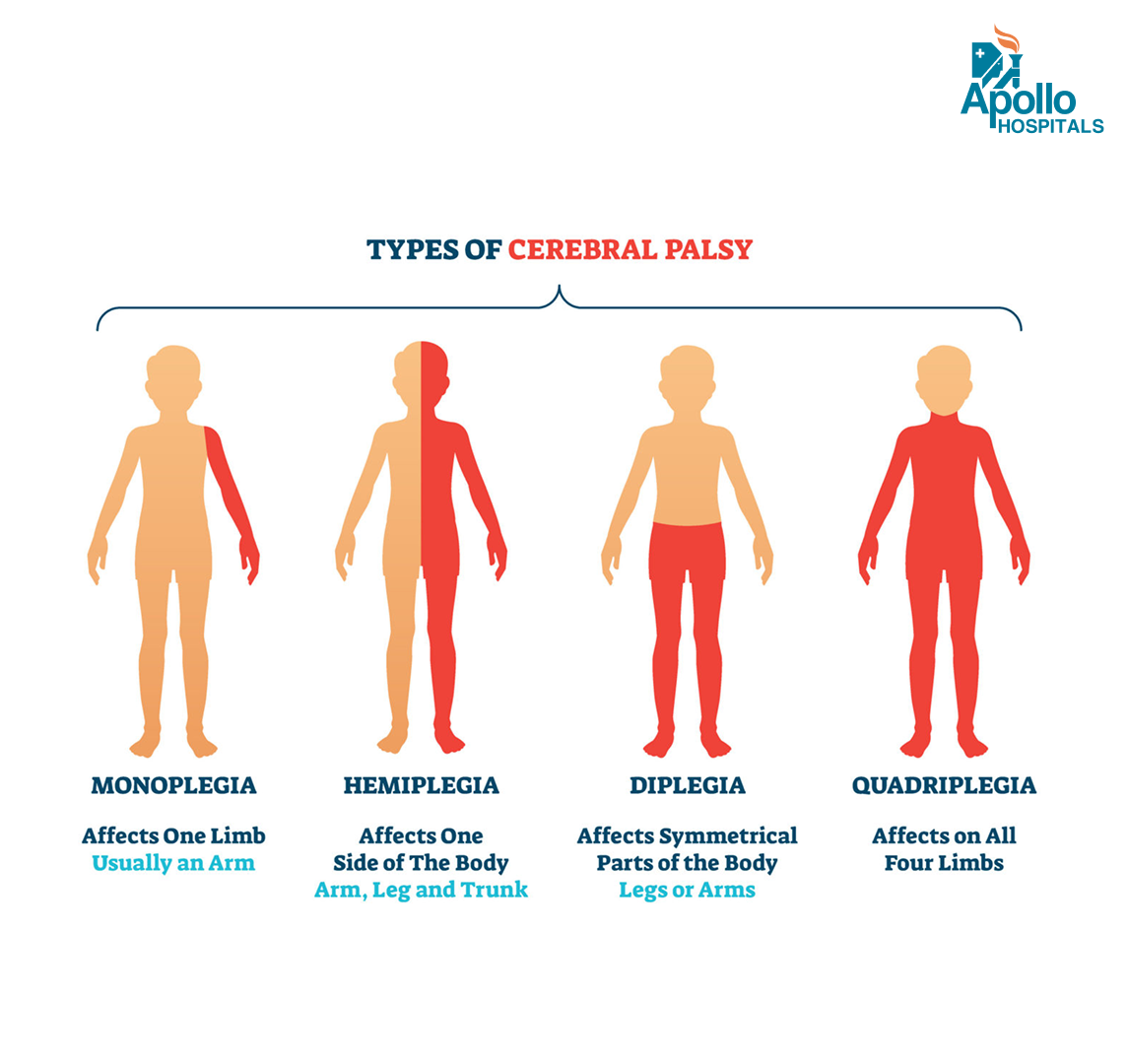 Cerebral Palsy Causes Symptoms Types Diagnosis And Treatment