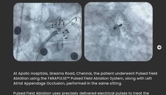 Team at Apollo Hospitals Chennai Combines PFA and LAA Closure for Patient with Atrial Fibrillation and High Bleeding Risk 