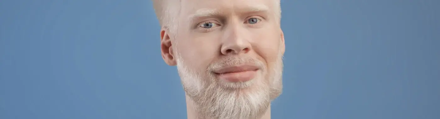 Albinism: Types, Causes, Symptoms  and Treatment
