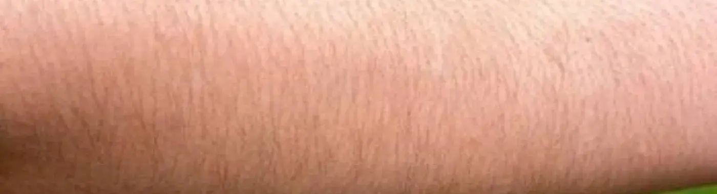 Hirsutism – Causes, Symptoms and Treatment