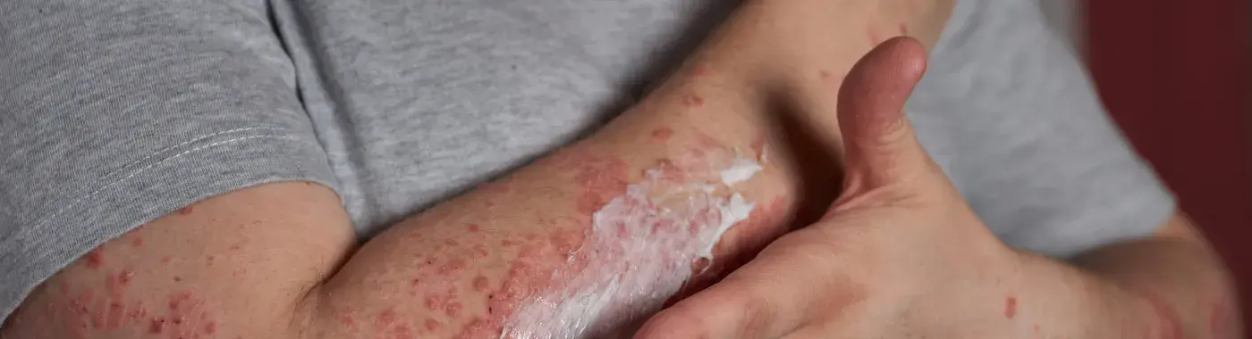 Autoimmune Disease: Types, Symptoms, Causes and Treatment