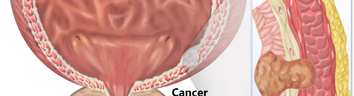 Bladder cancer – Symptoms and Causes