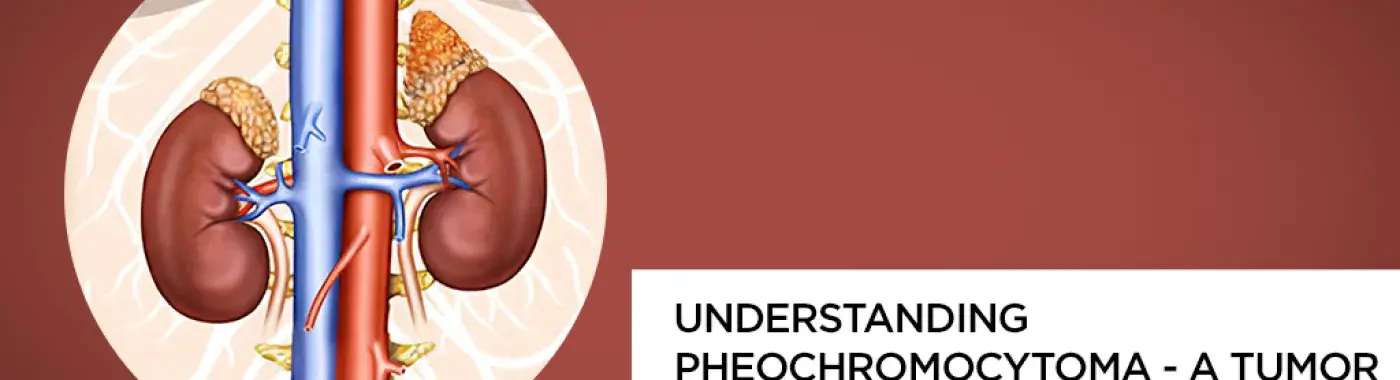 Understanding Pheochromocytoma – A Tumor that can Trigger High BP