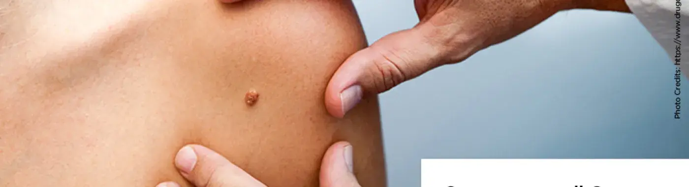 All About Squamous-cell Cancer