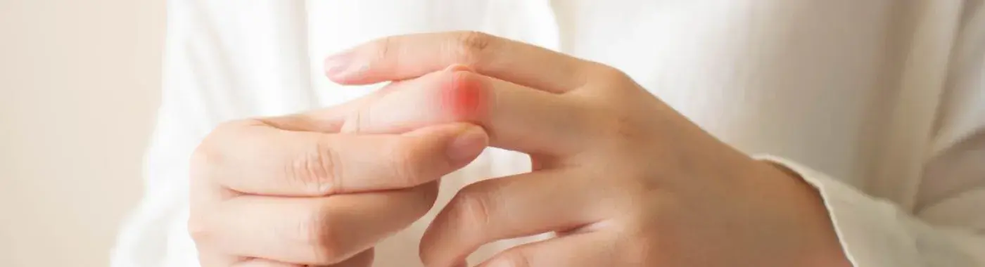 Boutonniere Deformity: Causes, Symptoms, and Treatment