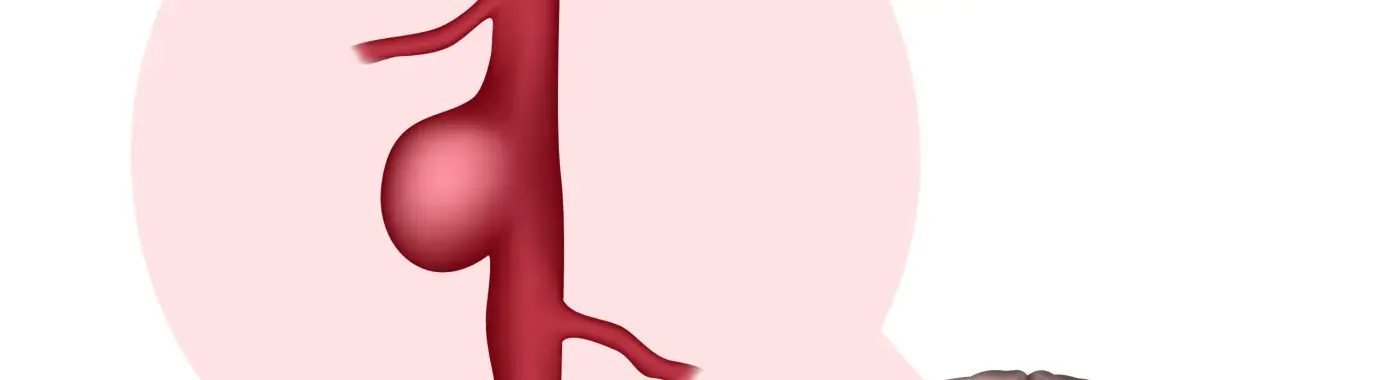 Brain Aneurysms – Types, Causes, Symptoms and Treatment