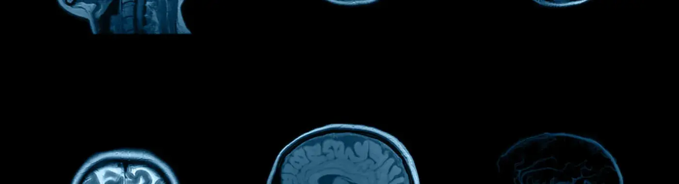 Brain Lesions – Symptoms, Causes, Types and Treatment