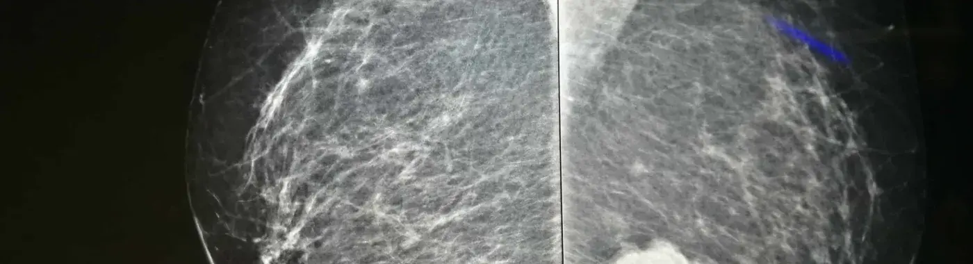 Breast Calcifications – Symptoms, Causes And Treatment