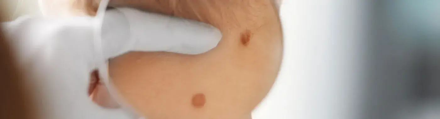 Carcinoma : Symptoms, Causes and Treatment