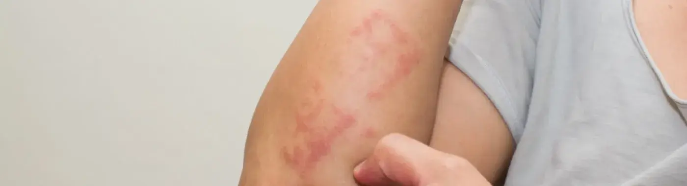 Contact Dermatitis: Causes, Symptoms, and Treatments