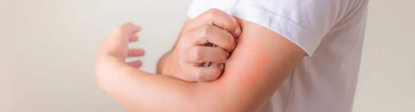 Dermatographia – Causes, Symptoms, Treatment, Diagnosis and Prevention