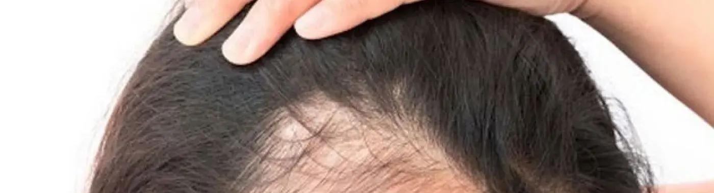 Things to Keep in Mind About Female Pattern Baldness