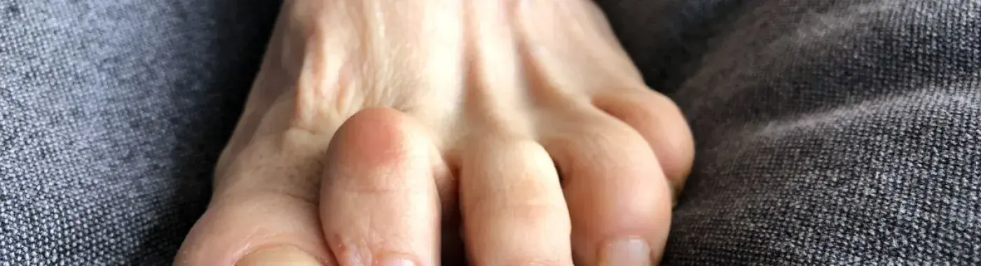 Hammer Toe: Causes, Symptoms, and Diagnosis