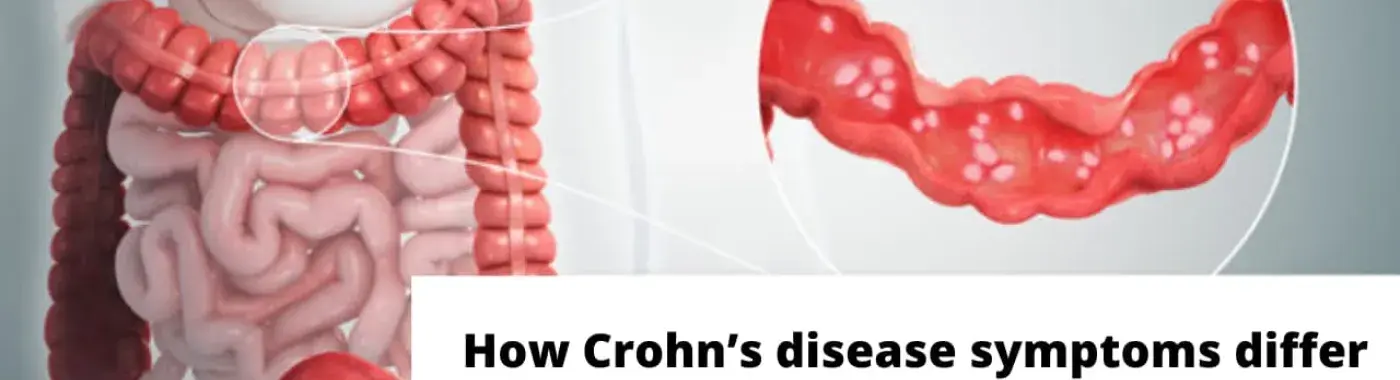 How Crohn’s disease symptoms differ from ulcerative colitis?