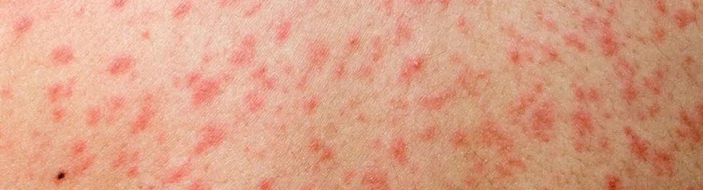 Measles: Know about the causes, symptoms & prevention