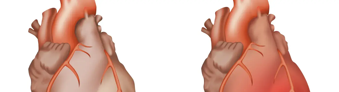 Pericarditis – Types, Symptoms, Causes, Treatment and Prevention