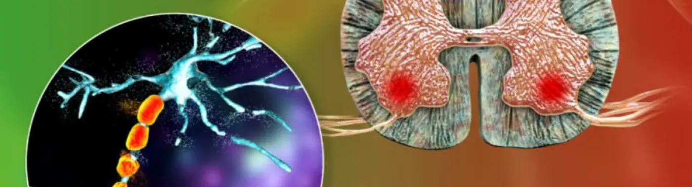 Primary Lateral Sclerosis (PLS) – Symptoms, Causes And Treatment