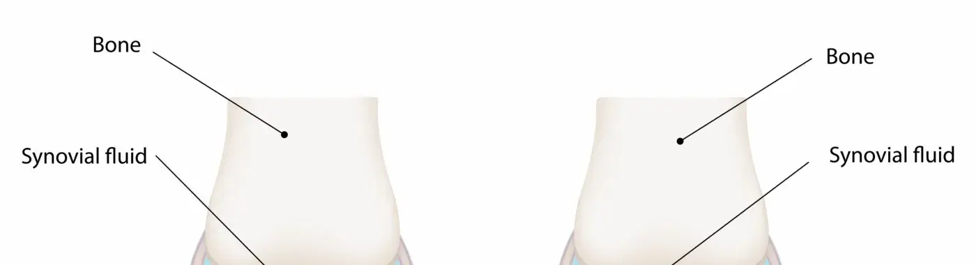 Pseudogout – Symptomsc Causes And Treatment