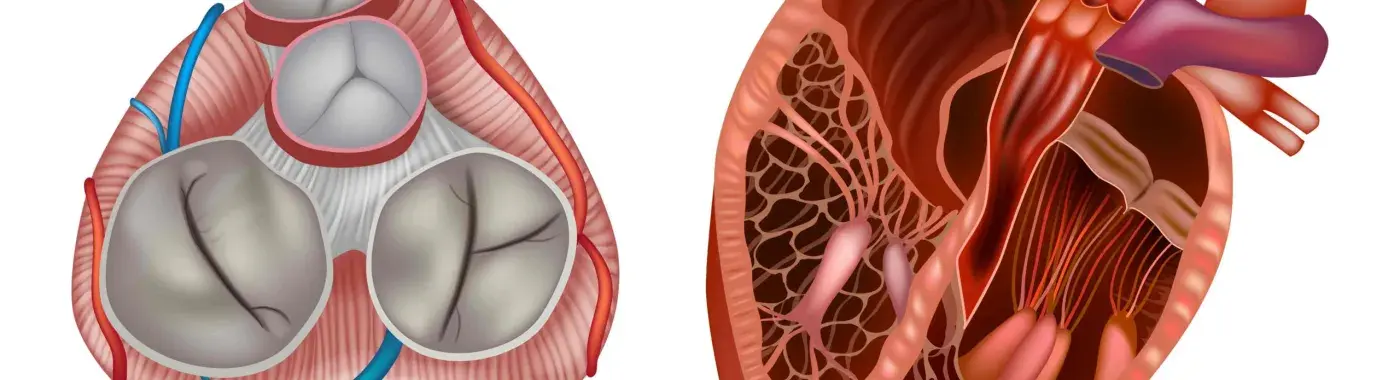 Pulmonary Valve Stenosis