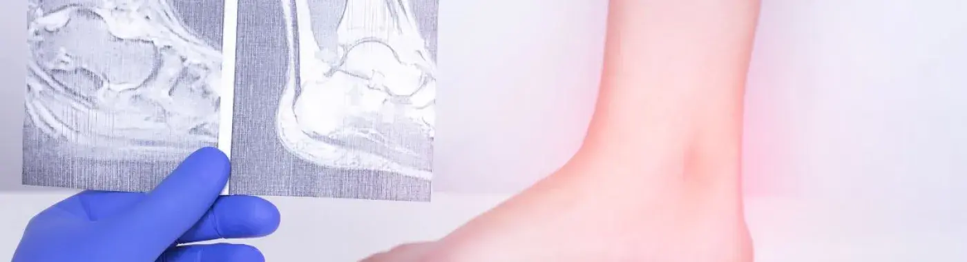 Reactive Arthritis – Symptoms, Causes and Treatment