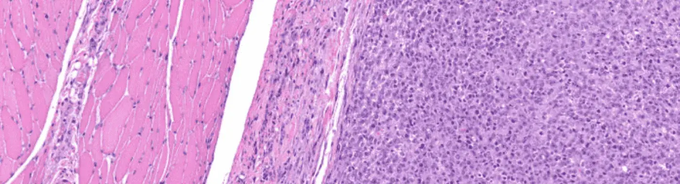 Rhabdomyosarcoma