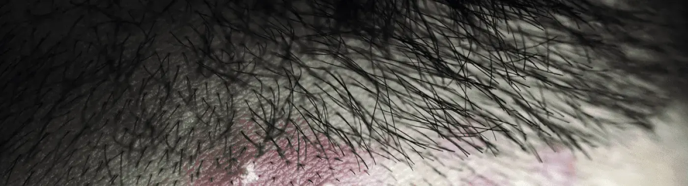 Scalp Folliculitis – Causes, Symptoms and Treatment